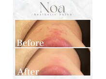 ノア 新宿(Noa)の雰囲気(ハーブピーリング/ニキビケア/毛穴/美肌/ホワイトニング/新宿)