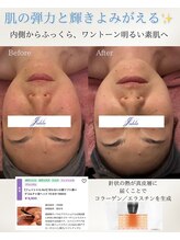 ユフラ(Juhla)/切らない小顔リフト