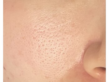 エムアンドユウ(m&u)/頬の毛穴の開き