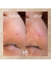 ウリ(uli beauty)/比較写真