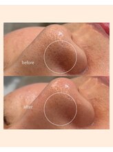 レア(Lea)/黒いポツポツ毛穴も綺麗に＊