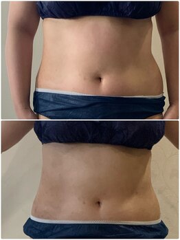 ヴィオテラス(VIOTERACE)/2ヶ月ダイエット☆