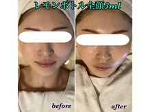 カラーリリー(calla lily)/レモンボトルフェイシャル