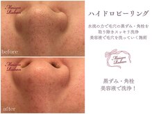 メゾンリュバン 梅田店(Maison Ruban)/毛穴洗浄|毛穴ケア