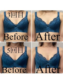 クオン(Qon)/BBLバストケアの途中経過☆
