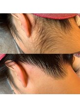 アート 熊本並木坂店(ART)/うなじ脱毛/フラッシュワックス