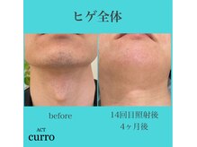 アクト クロ(ACT curro)/【ヒゲ全体】脱毛施術例