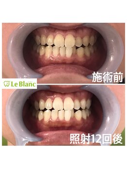 ルブラン 奈良店(Le Blanc)/６日間で白く！！