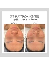 ポムハヌル 大阪梅田中崎町(pom.haneul)/韓国肌管理室