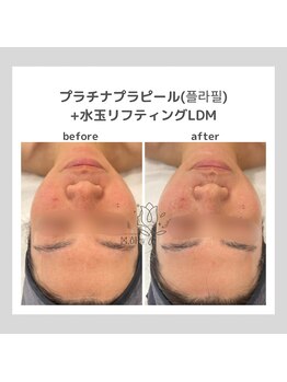 ポムハヌル 大阪梅田中崎町(pom.haneul)/韓国肌管理室