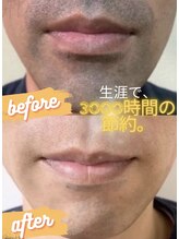 デェア コミータ/ヒゲ脱毛のビフォーアフター