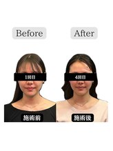 クリアランス(CLEARANCE)/施術回数4回 担当者TAIGA