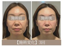 ドクターボディ 恵比寿店(Dr.Body)/【ほうれい線/エラ張り 40代】