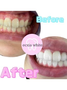 エクシアホワイトニング 武蔵小杉店/ビフォーアフター