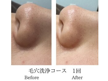 ミーシェ(Meshie)/毛穴ハイドラフェイシャル