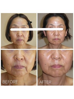 カノン(KANON)/グリーンピール