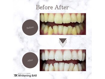 ホワイトニングバー 金沢フォーラス店