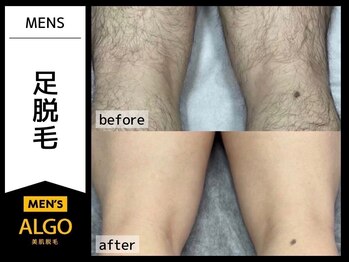 アルゴ 敦賀店(ALGO)/20代男性12回目　メンズ足脱毛