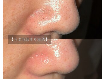 ル シーニュ/うぶ毛詰まり30代