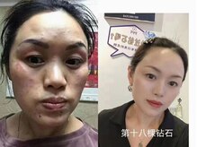 ステップイン(Step in)/ダイヤモンドピールプログラム