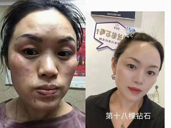 ステップイン(Step in)/ダイヤモンドピールプログラム