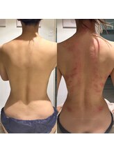 ビレイ(Birei)/全身カッサ