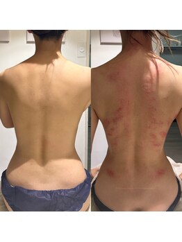 ビレイ(Birei)/全身カッサ