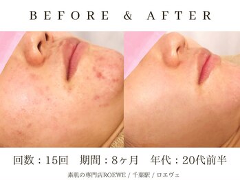 ロエヴェ(ROEWE)/ニキビ改善・毛穴ケア・肌質改善