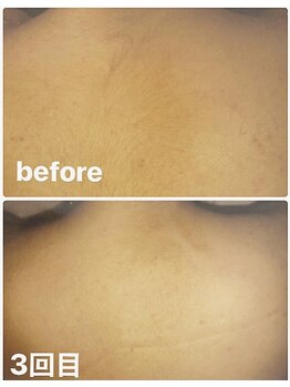 ラウレア 西条店(LAULEA)/背中脱毛(befor/after)