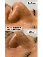 シロ(SHIRO)/お鼻の黒ずみが一掃