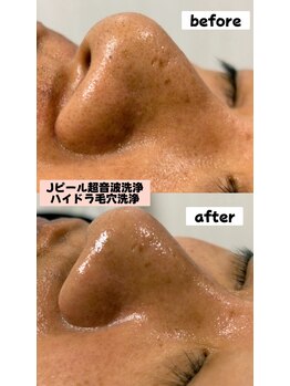 シロ(SHIRO)/お鼻の黒ずみが一掃