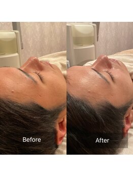 ステラグランデ(Stella grande)/毛穴リセットラボ