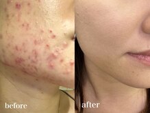 慢性的なニキビも改善できます