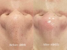 ウルト アルティメイトスキン(ULT ultimate skin)/頑固な鼻の黒ずみ