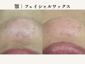 ティアラ(TIARA)の写真/★広島希少顔脱毛★【産毛・角質・顔ダニ・肌のざらつきに】天然成分100%マツヤニを使用した天然ピーリング