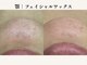 ティアラ(TIARA)の写真/★広島希少顔脱毛★【産毛・角質・顔ダニ・肌のざらつきに】天然成分100%マツヤニを使用した天然ピーリング