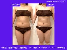フェレザ 新潟(Felleza)/キャビテーション-超音波