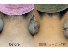 サロンドジェシカ(salon de Jessica)/うなじ脱毛/美肌脱毛