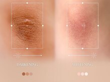 ジジベレッザ 芦屋店(jiji belleza)/lemella (ルメラ)/最新韓国美容