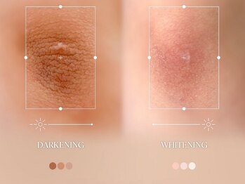 ジジベレッザ 芦屋店(jiji belleza)/lemella (ルメラ)/最新韓国美容