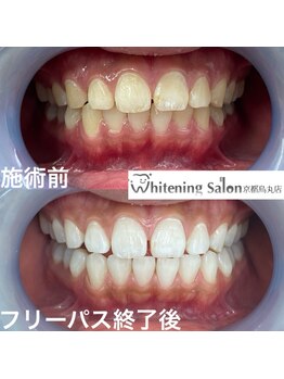 ホワイトニングサロン 京都烏丸店/ホワイトニング施術例　
