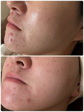 ナナプラス(nana plus)/ニキビ毛穴