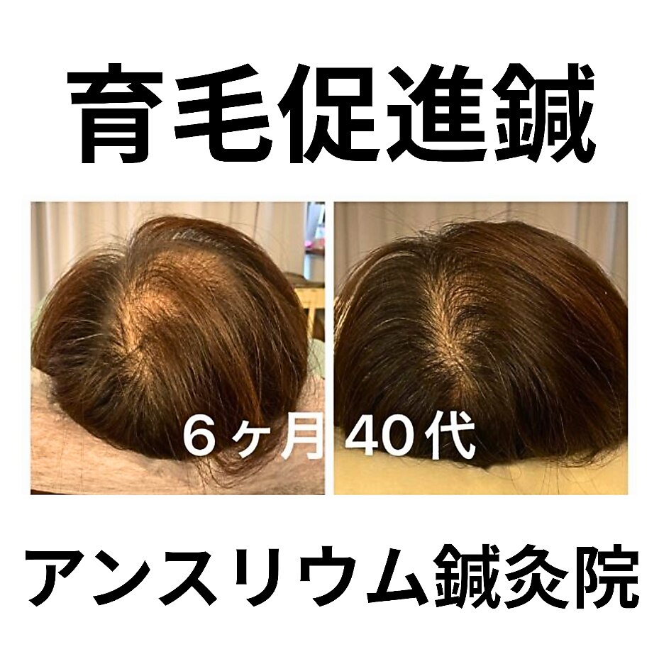 本気の方限定【抜け毛ケア専用鍼】太く強く抜けにくく/初回カウンセリング