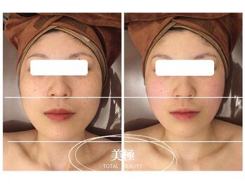 美極 トータルビューティー(美極 TOTAL BEAUTY)/恵比寿/小顔コルギ/エステ
