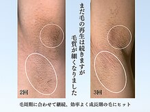 アンジェリーナ/メンズフラッシュ脱毛/ワキ