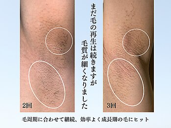 アンジェリーナ/メンズフラッシュ脱毛/ワキ