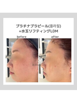 ポムハヌル 大阪梅田中崎町(pom.haneul)/韓国肌管理室