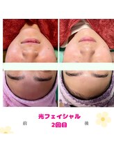 ローズ 下松(ROSE)/大人気！根本から肌を変える