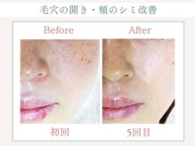 トータルビューティー ゆみえエステ(Total Beauty)/光フォト