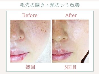 トータルビューティー ゆみえエステ(Total Beauty)/光フォト